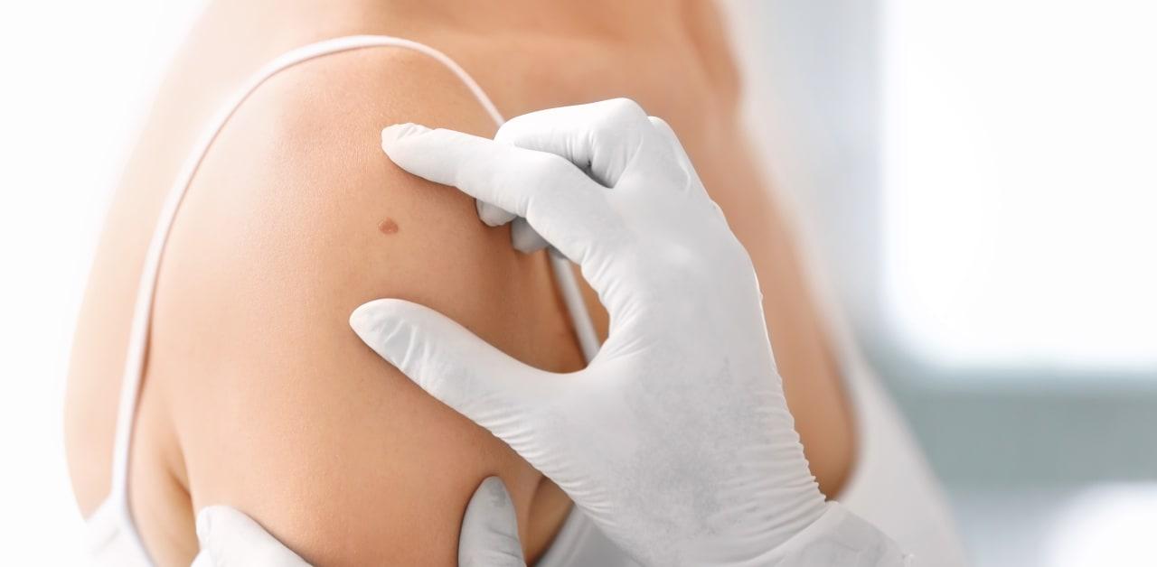 The use of nicotinamide reduces SCC for veterans and original skin cancer