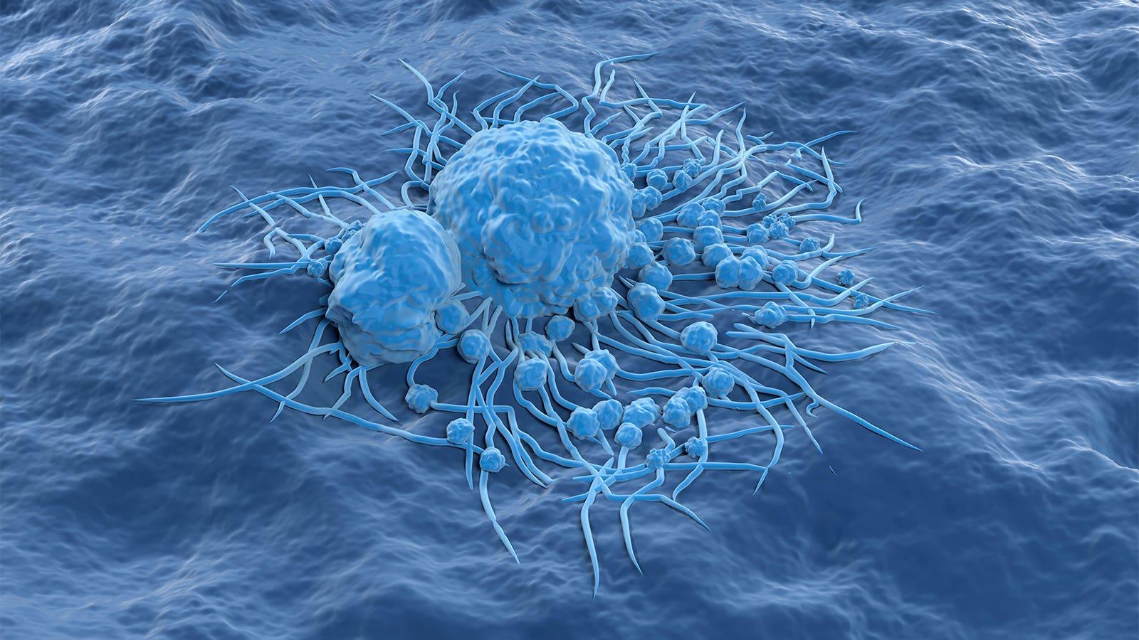 Global study says many cancers on the rise among adults of all ages |Medpage Tod...