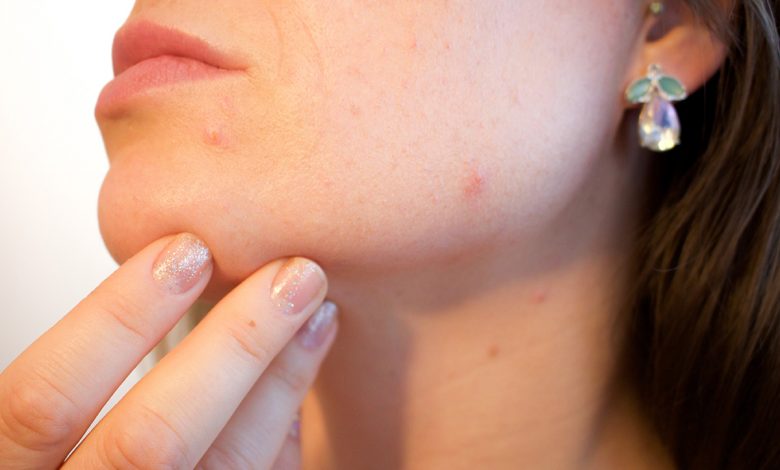 If pimples appear in these areas of the face, they want to tell us something about our state of health