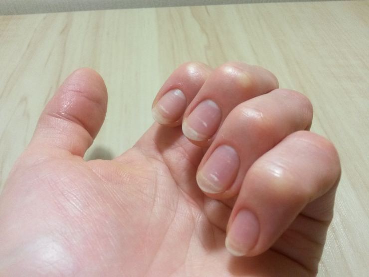 brittle nails treatments