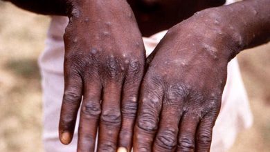 Photo of The first case of monkeypox was identified in Emilia-Romagna
