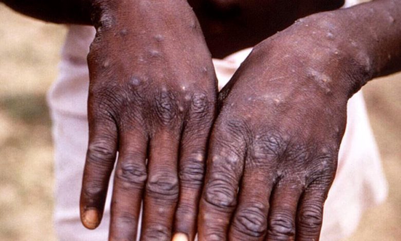 The first case of monkeypox was identified in Emilia-Romagna